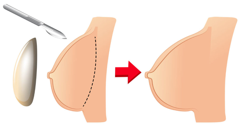 planując operację powiększenia piersi