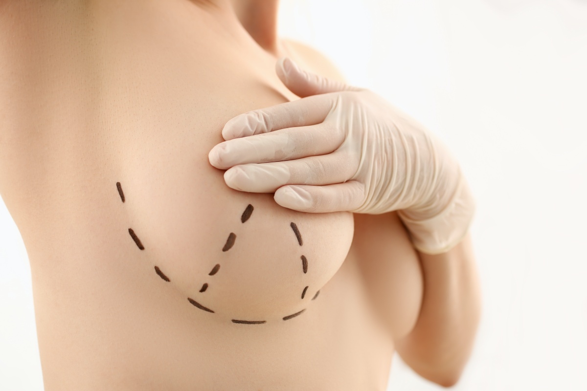 usunięcie implantów po powiększeniu piersi