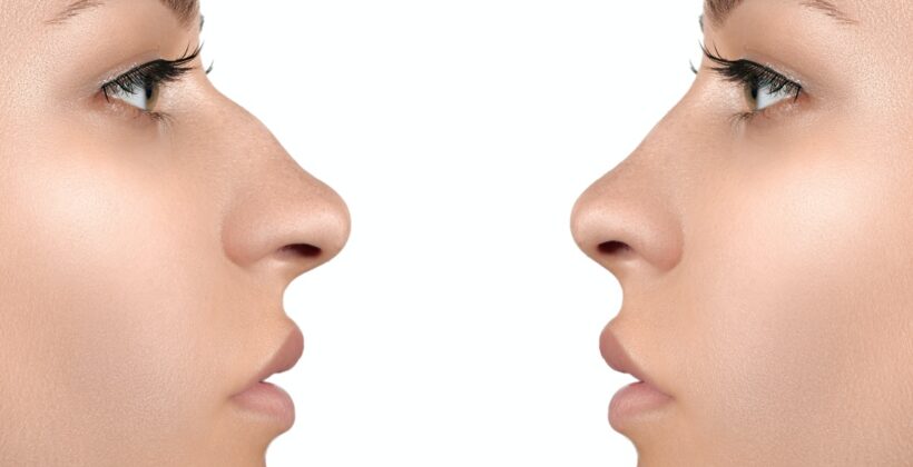 Korekcja nosa z osteotomią – dla kogo?