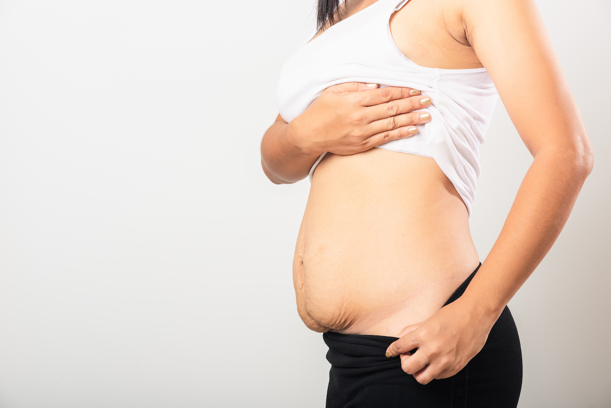 mommy makeover zabiegi po ciąży
jak przywrócić wygląd sprzed ciąży