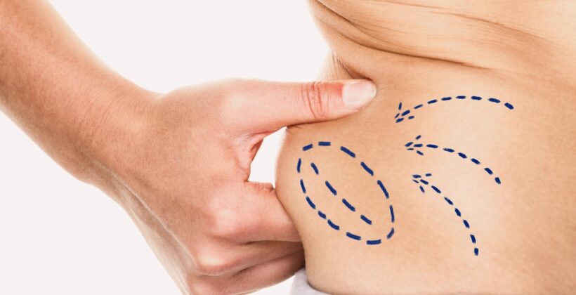 Muffin top na biodrach – kiedy liposukcja, a kiedy plastyka brzucha?