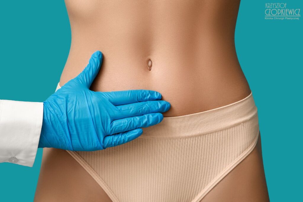 efekt abdominoplastyki